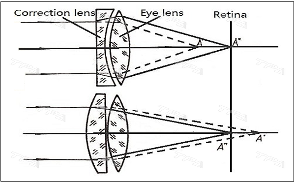  Nguyên tắc điều chỉnh thị lực